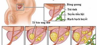 Đèn led GaN phát hiện bệnh ung thư tuyến tiền liệt